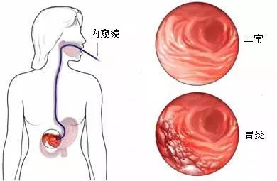 一枚小膠囊，看清你的胃！