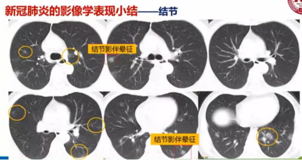 AI助力疫情防控，專利為其保駕護(hù)航！