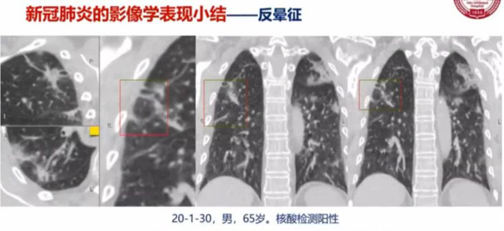 AI助力疫情防控，專利為其保駕護(hù)航！